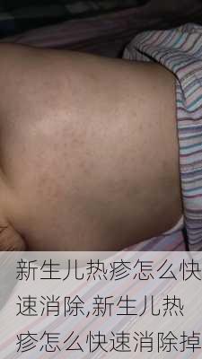 新生儿热疹怎么快速消除,新生儿热疹怎么快速消除掉